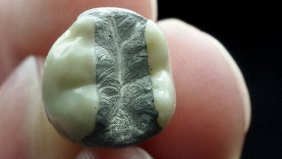 Alternative medicine used to cure amalgam-attributed health complaints