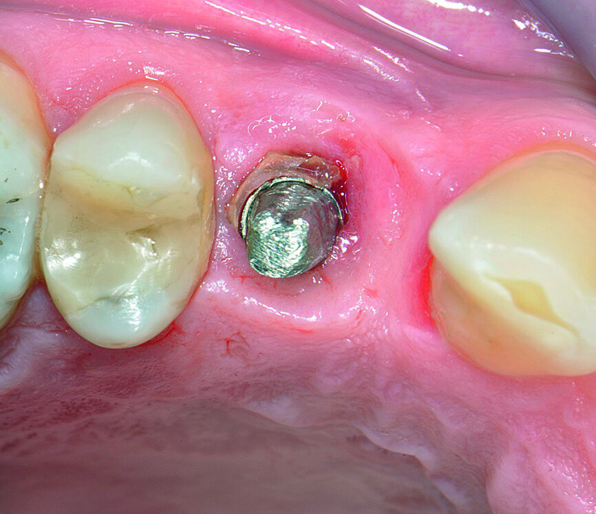 Fig. 3: Excess resin cement around the implant.