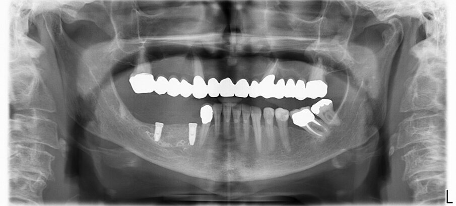Fig. 10_Ortopantomografia dopo rimozione della griglia e inserimento degli impianti. 