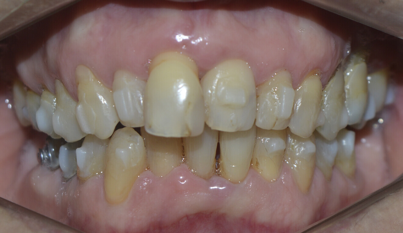 Fig. 8: After periodontal treatment.