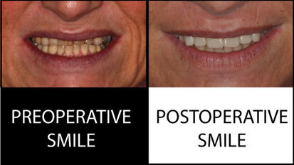 All-ceramic rehabilitation with CAD/CAM restorations made of a zirconia–reinforced lithium silicate