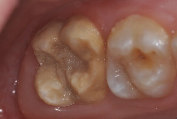 The photograph shows a severe form of MIH. The tooth on the left erupted incompletely developed. The molar was highly sensitive to cold and touch, and brushing was painful, as evident from the surface deposits. The second molar was also affected by the condition. (Photograph: Prof. Norbert Krämer)