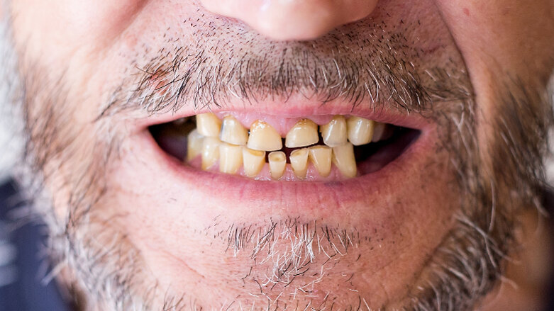 Pandemic causing increase in stress-related oral health conditions