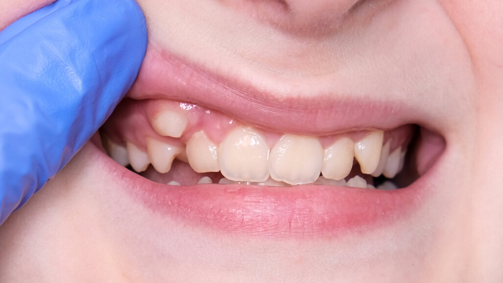LightForce Orthodontics dành được khoản tài trợ cho mắc cài in 3D