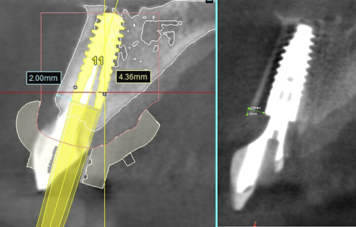 Fig. 17: A follow-up CBCT scan demonstrated the perfectly executed positioning of the implant as it had been planned.