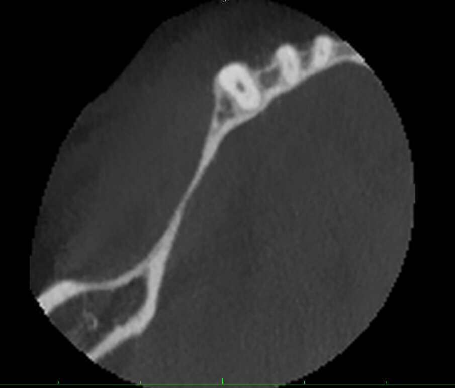 Figg. 1a-1c_Foto clinica e sezioni di CBCT iniziali in cui si evidenzia l’edentulia distale a elemento 4.3 con atrofia orizzontale estremamente accentuata e lieve atrofia verticale.