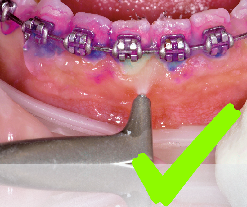 Fig. 1: AIRFLOW in action on orthodontic brackets