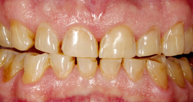 Full-mouth restoration with Zolid&nbsp;FX— a successful concept for sophisticated prostheses