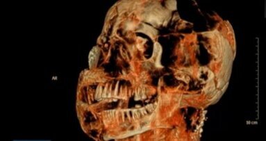Novos exames de tomografia computadorizada revelam que as vítimas de Pompeia tinham dentes excelentes
