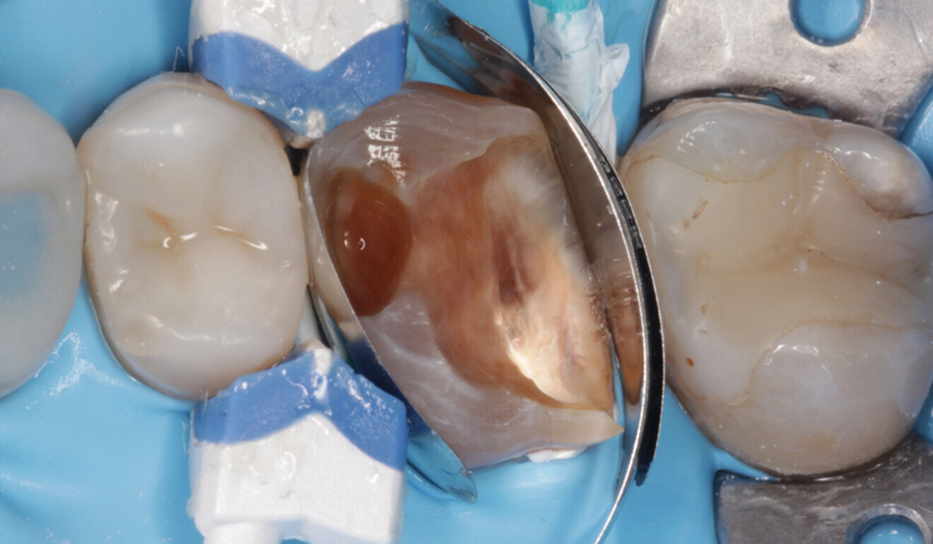 Fig. 10: New, longer and more curved matrix in place. (Image: Kuraray Noritake Dental)