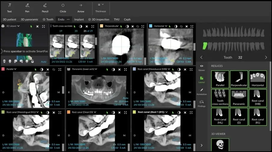 Фиг. 14 Представяне на ендодонтския режим на DTX Studio Clinic и различните участъци от областта и отношенията между долночелюстния канал, проследен от софтуера, и корените на молара.