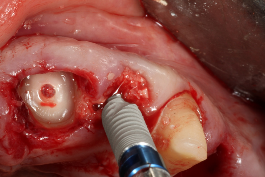 Fig. 7: Immediate implant placement into the fresh extraction socket of tooth #22 after ridge grafting with autologous dentine.