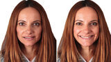 Fig. 2b: Fotografías extraorales después del tratamiento de ortodoncia.