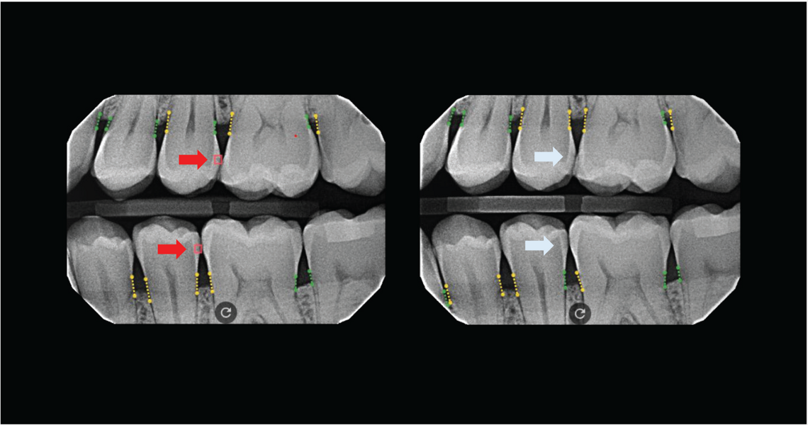 Treatment with Curodont Repair Fluoride Plus: Before (left) and after six months. (Images: Dr. Rebecca Pounds)