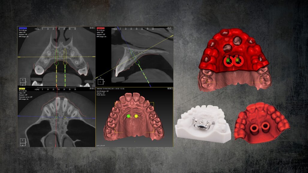 Orthodontic appliances on temporary anchorage devices: Single-stage procedure