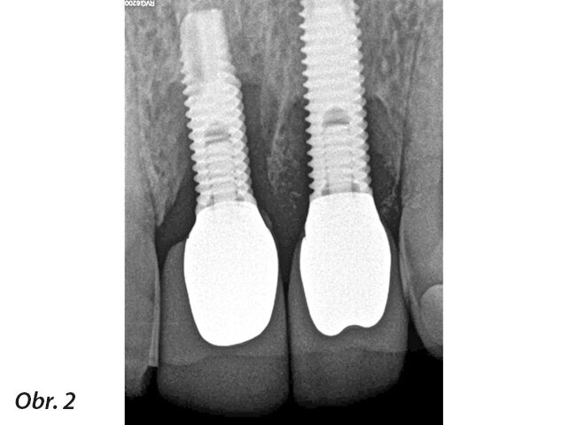 Radiografické vyšetření odhalilo pokročilou periimplantitis u nedávno zavedených implantátů