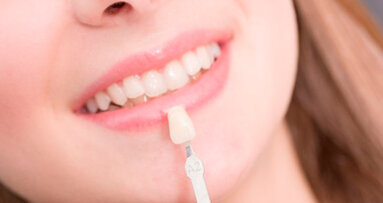 Il mercato dell’odontoiatria estetica raggiungerà i 22 miliardi di dollari entro il 2020