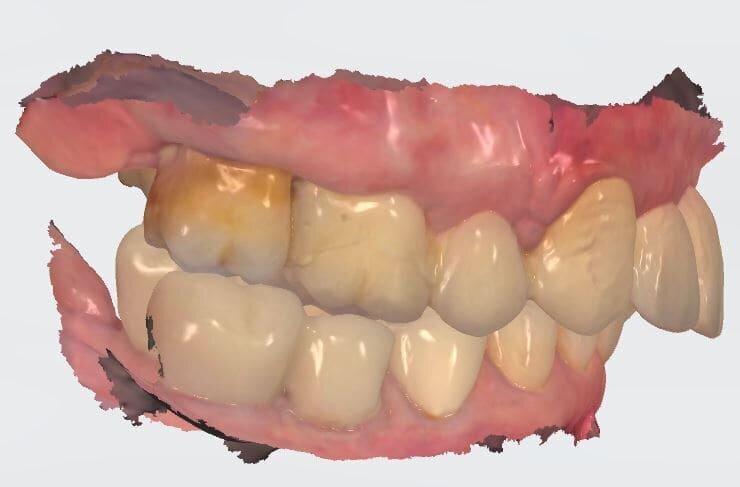 Fig. 29_A provvisorio posizionato abbiamo rilevato le impronte per definire la corretta posizione coronale e l’emergenza estetica. 