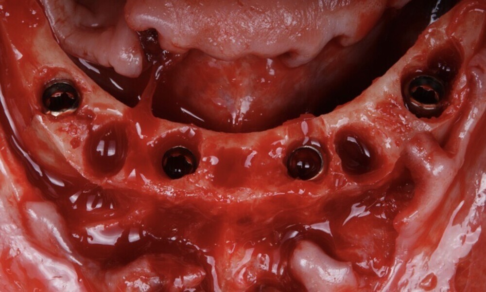 Figs. 44–46: The implants and screw-retained abutments were placed
