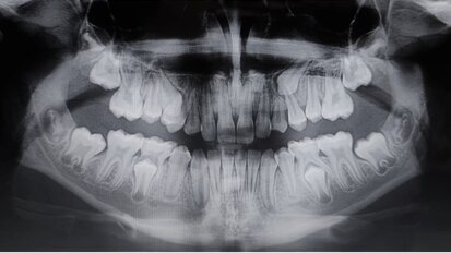 Management ortodontico delle trasposizioni dentali