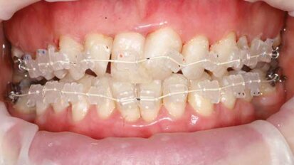 Simple and predictable short-term cosmetic tooth alignment: A case study