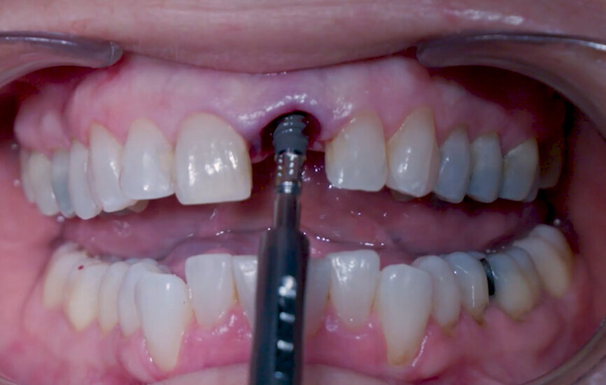 Fig. 10: Implant placement with surgical handle.
