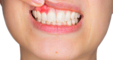 Study of 50 years of literature on periodontitis reveals obvious link