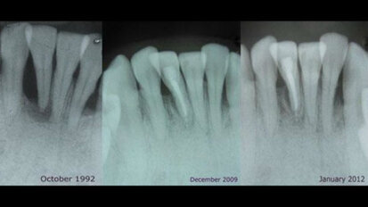 La placca dentale può essere utilizzata per il trattamento e la previsione delle malattie