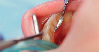 Porównanie efektów laseroterapii ręcznej, ultradźwiękowej i Er:YAG w leczeniu chorób przyzębia