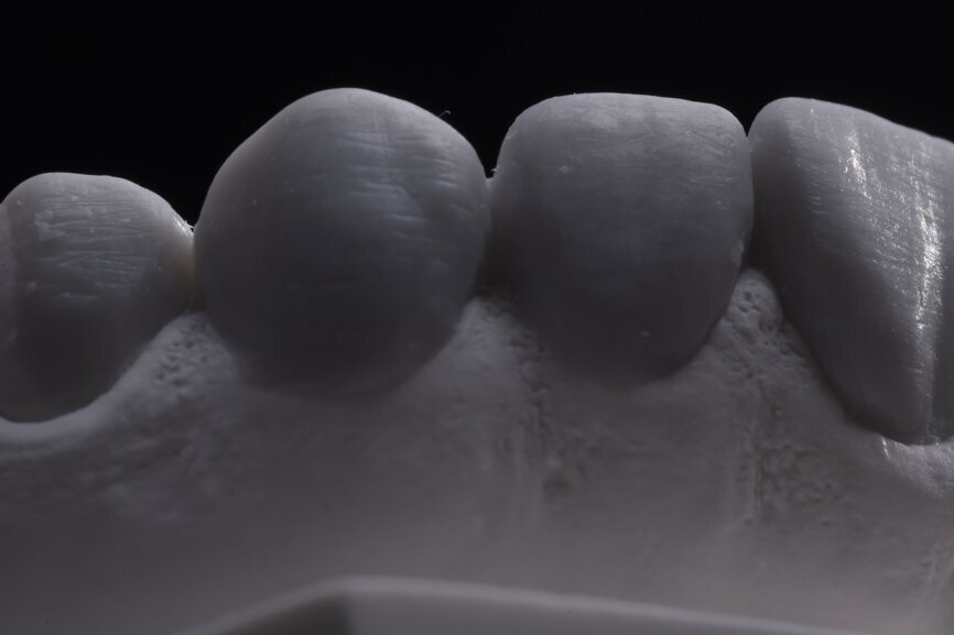 Fig. 30: Final wax-up of all units.