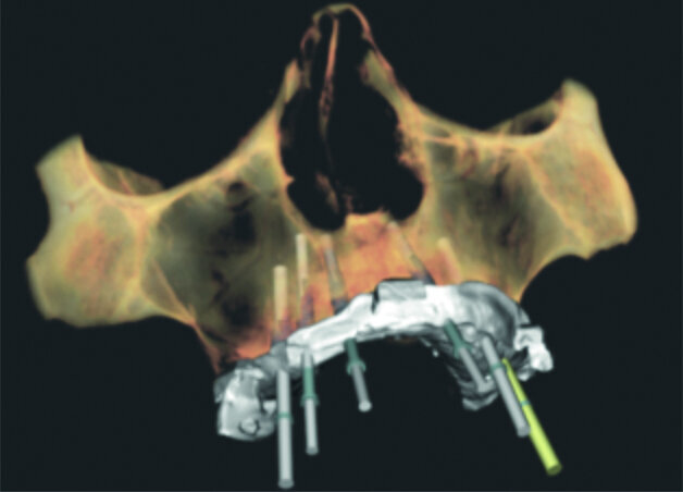Fig. 9 : Empreintes optiques matchées avec le CBCT et la planification implantaire.