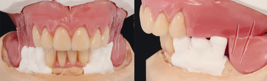Figs: 4 and 5: The teeth were set up on the models that were articulated in line with the jaw relation.
