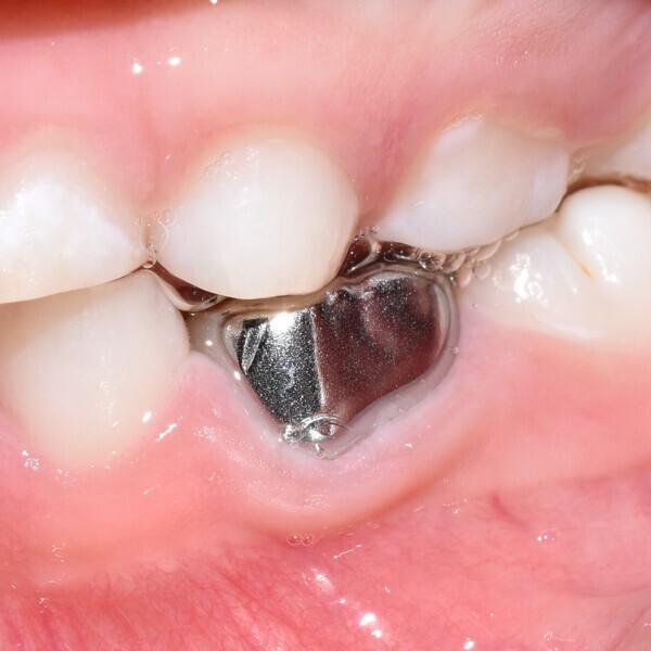 Fig. 18 : Aspect clinique lors de l’évaluation finale montrant un tissu gingival sain.