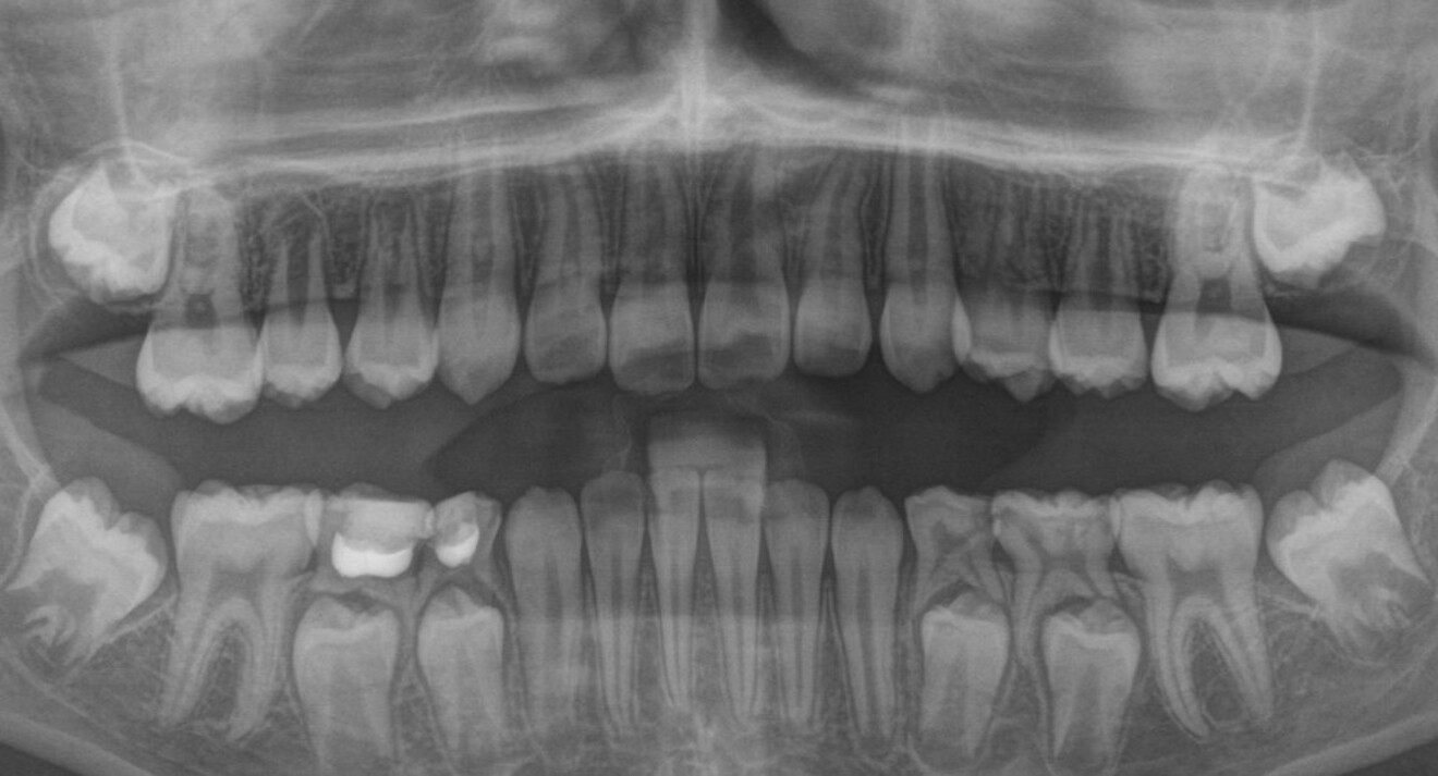 Fig. 4b: Post-treatment panoramic radiograph.
