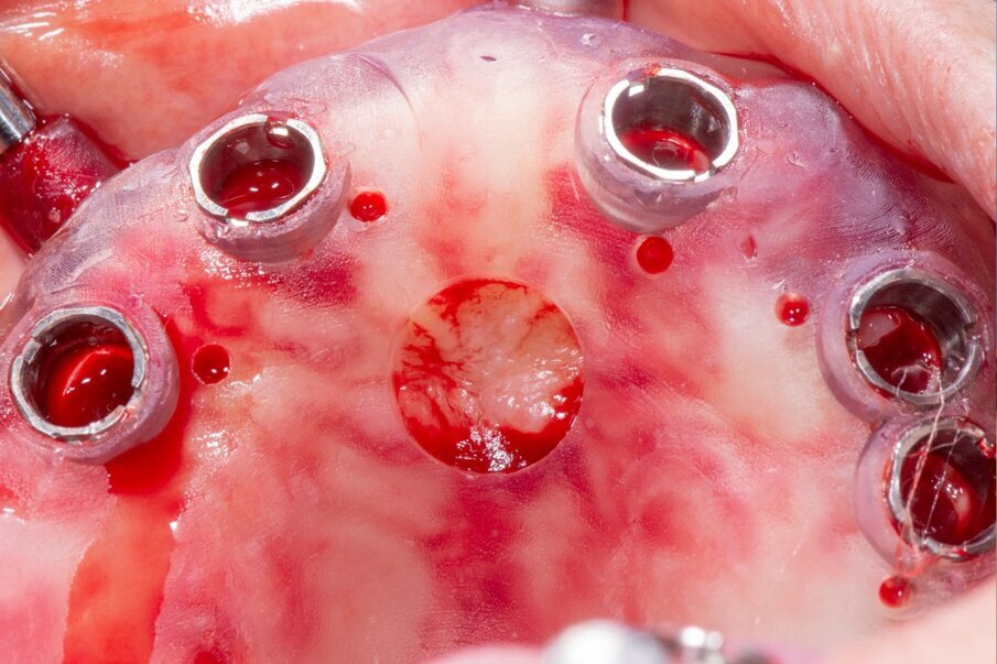 Fig. 8_Fissaggio dima superiore.