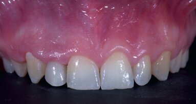 Comprehensive rehabilitation and natural esthetics with implant and orthodontics (CRANIO): An interdisciplinary approach to missing maxillary lateral incisors