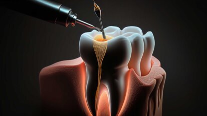 Revolutionäre Endodontie: Die Macht der Digital Geführten Therapie