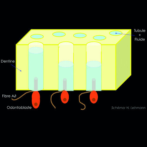 Fig. 1 : Schema illustrant l’origine des
sensibilites pulpo-dentinaires selon la
theorie hydrodynamique. 
