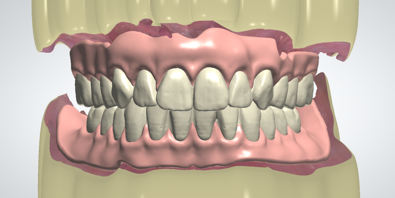 Fig. 2: Virtual set-up in Dental Designer.