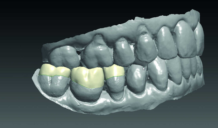 Fig. 5 : Wax-up virtuel