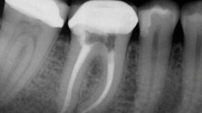 Rewizja leczenia endodontycznego – jak osiągnąć sukces przy drugim podejściu