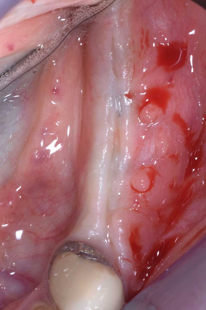 Fig. 9b - La cresta a 6 mesi di distanza.