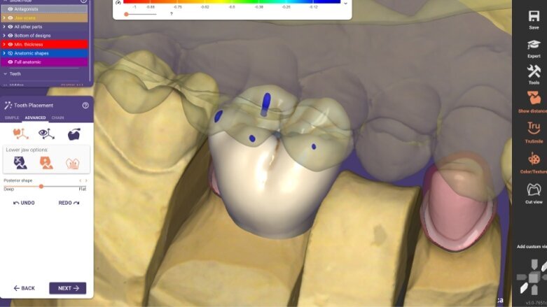 Exocad gibt Roll-Out von DentalCAD 3.0 Galway bekannt