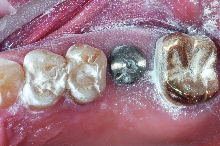 Fig. 7: With its specific notches, the gingiva former also acted as a scanbody.