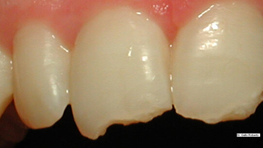 Implantologia nei settori estetici mediante l’uso di abutment personalizzabili