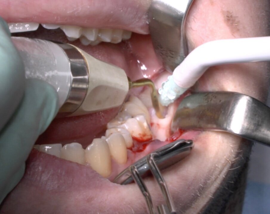 Fig. 6_Terminale piezoelettrico in azione.