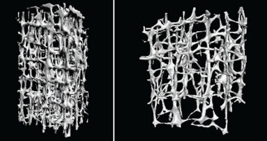 Osteoporosis and bisphosphonates