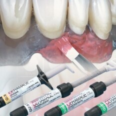 Indirect Composite