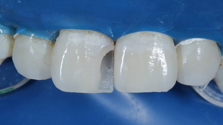 Fig 12: Palatal Shell (Free Hand)