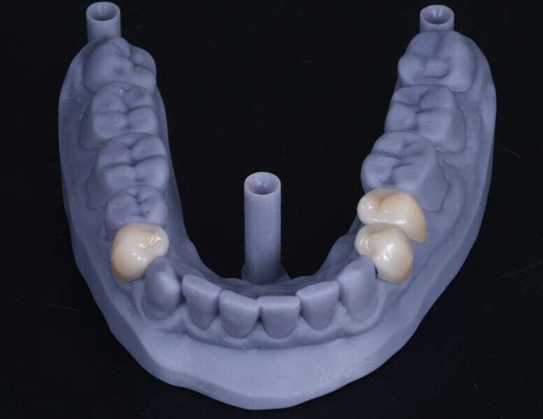 Fig. 5a &b: Vertical dimension of occlusion augmentation.
